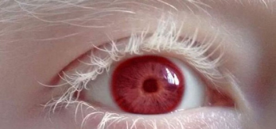 7 Poin Penting yang Harus Diketahui Tentang Albinisme (Albino)